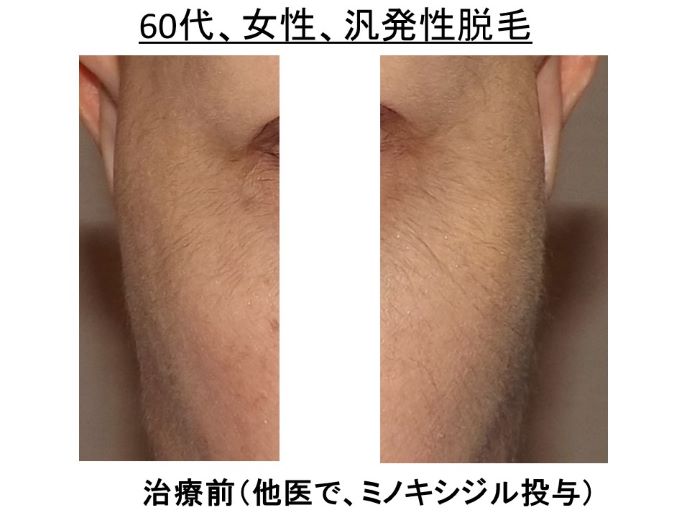 円形脱毛症　病院